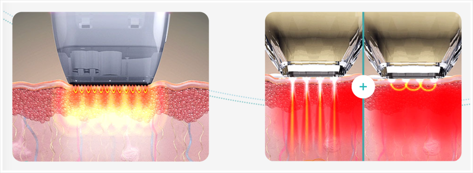 강남 포텐자, 모공 제대로 줄이고 싶다면 3가지 조건 알고 가세요 관련 이미지 10