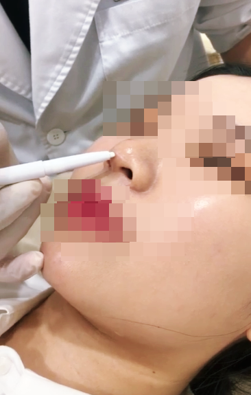 무턱필러 선택 자연스럽게 지속되는 볼륨과 탄력 쥬비덤 관련 이미지 5