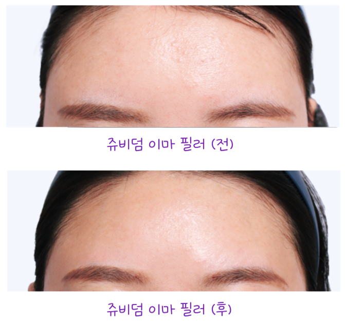 이마 필러 쥬비덤필러 자연스럽게 하려면 몇 cc 필요할까 관련 이미지 2