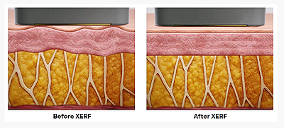 세르프 리프팅 효과와 통증까지 완벽정리 관련 이미지 2