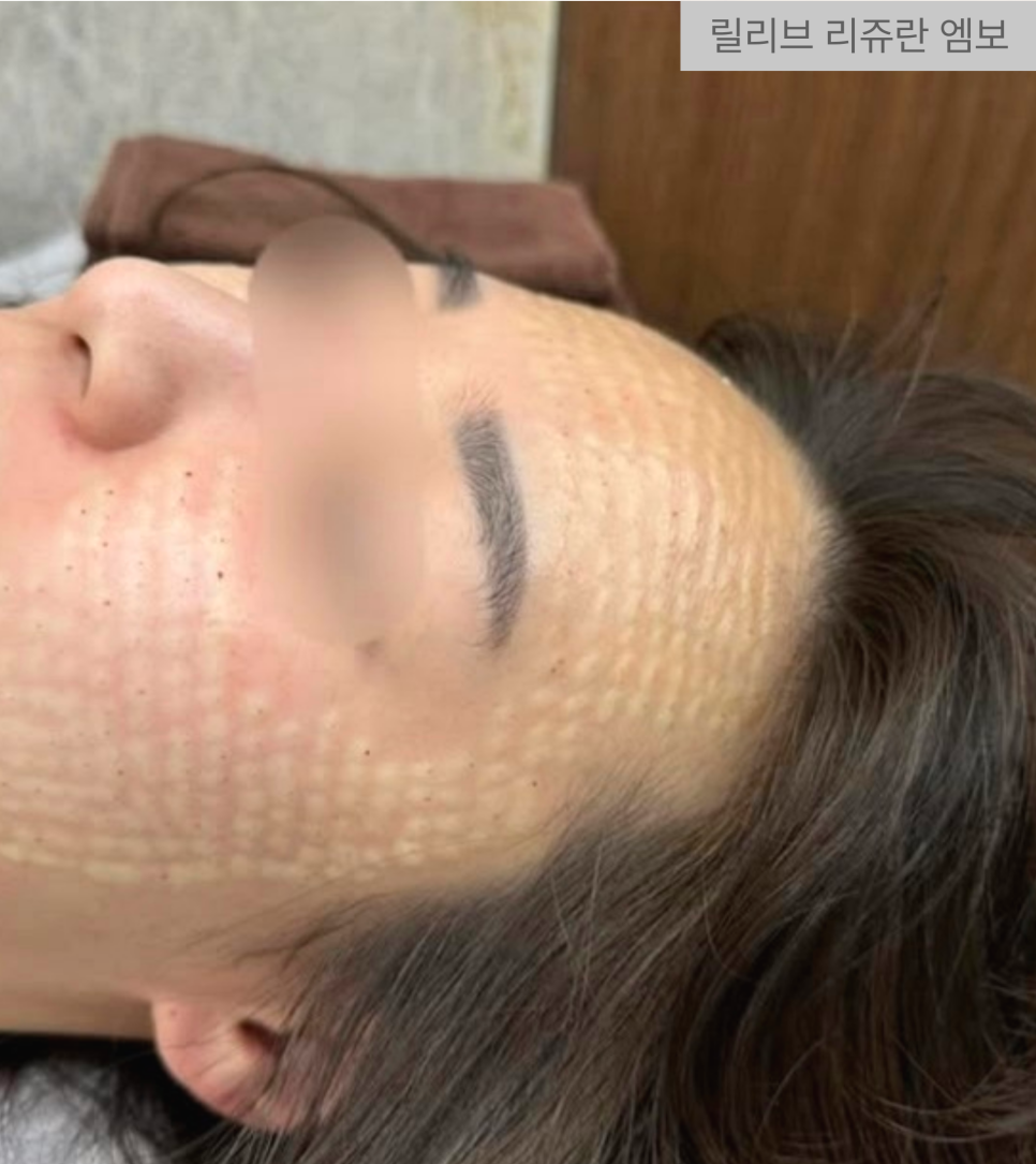 리쥬란힐러 통증 엠보 현실적인 설명, 리쥬란 횟수는? 관련 이미지 5