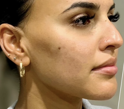 주베룩 볼륨, 필러는 무서우신 분들 관련 이미지 1