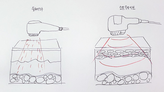 소프웨이브 리프팅 효과와 유지기간 울쎄라와 다른점 관련 이미지 4