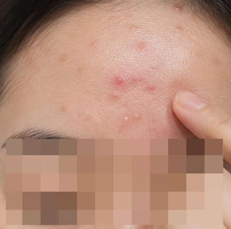 Recurrent Acne: Skin That May Benefit from Rejuran image 4