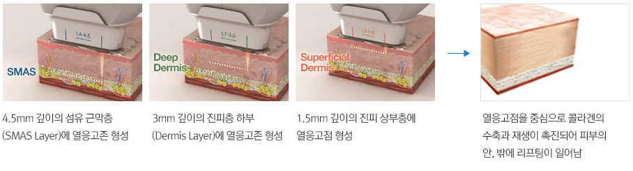 영통피부과 탱탱하게, 슈링크리프팅! 관련 이미지 9