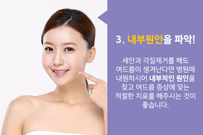 여름철 여드름 피부관리, 어떻게 해야 할까요? 관련 이미지 4