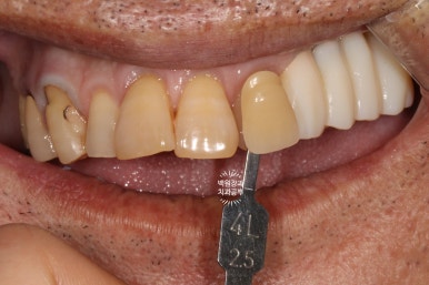 아래 어금니 임플란트 6개면 틀니를 안써도 됩니다.  치주염 전문 착한치과. 치료기간/임시치아과정/후기/비용. 관련 이미지 22