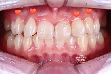 신사역 치과. 아나운서 면접 전 앞니 벌어진 공간을 라미네이트로만 해결할 수 있었던 사연.. 관련 이미지 12