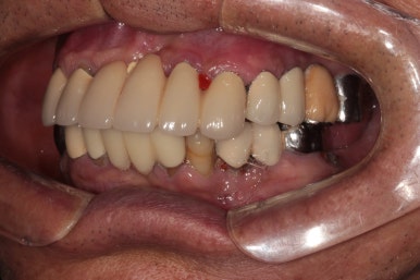 잇몸 염증 고름이 심했던 부위 - 만성치주염 진단하고 임플란트로 깔끔하게 치료! 신사역 치과 관련 이미지 6