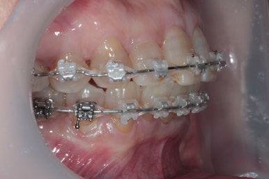 삐뚤어진 앞니를 8개월만에 가지런하게 만드는 50대 성인부분교정. 신사역 교정치과. 치료과정/기간/비용. 관련 이미지 11