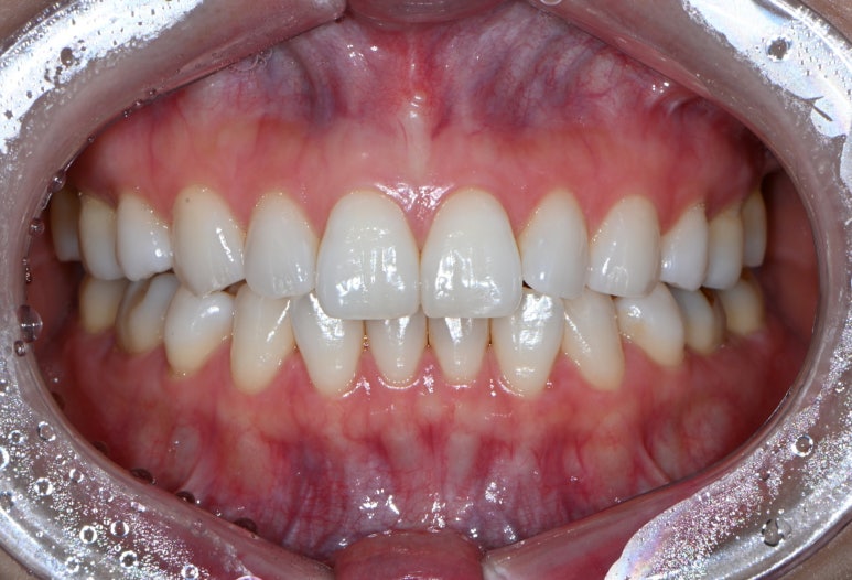 강남 치아미백 성지 레브치과. 가격/비용/부작용/전후사진. 관련 이미지 15