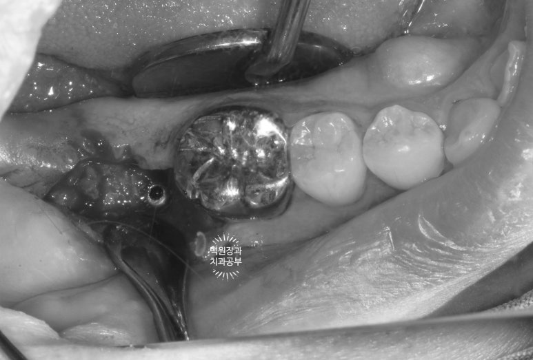 신경치료한 치아 부러짐! 뼈이식 하면서 임플란트 수술하는 과정/기간/비용. 관련 이미지 12