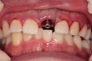 앞니 머리가 기둥째 부러졌어요. 발치 동시 뼈이식 오스템 BA 임플란트. 치료과정/치료기간/비용/후기. 압구정 치과. 관련 이미지 13