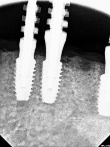 오스템임플란트 네비게이션 전체 임플란트 치료일기. 치료과정/치료기간/비용/솔직후기. 관련 이미지 18