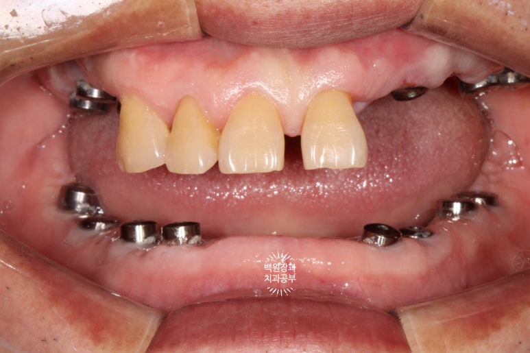 임플란트장인의 마음으로 8개월간 전체임플란트 완성. 치주과 전문의. 관련 이미지 20