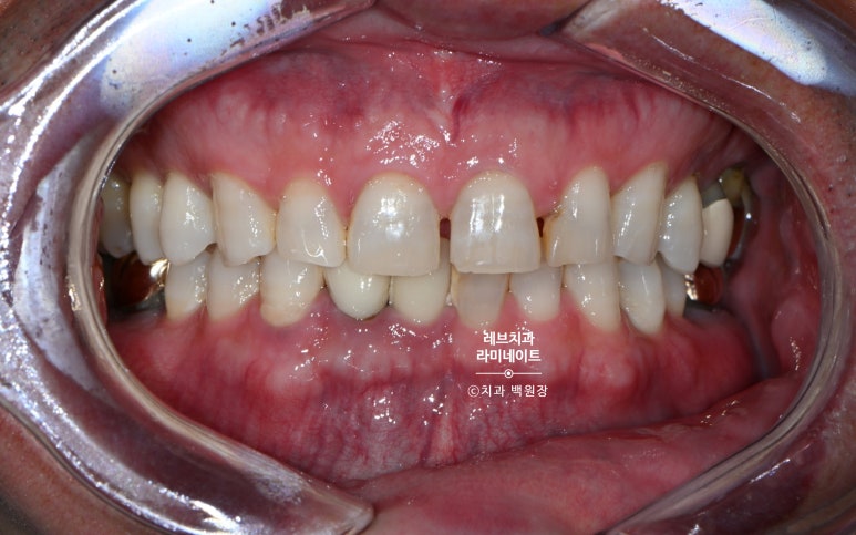 신사역 무삭제 라미네이트 : 레브네이트 내츄럴 최소삭제 비니어. 50대 앞니 벌어짐 비용/후기/얼굴사진. 관련 이미지 2