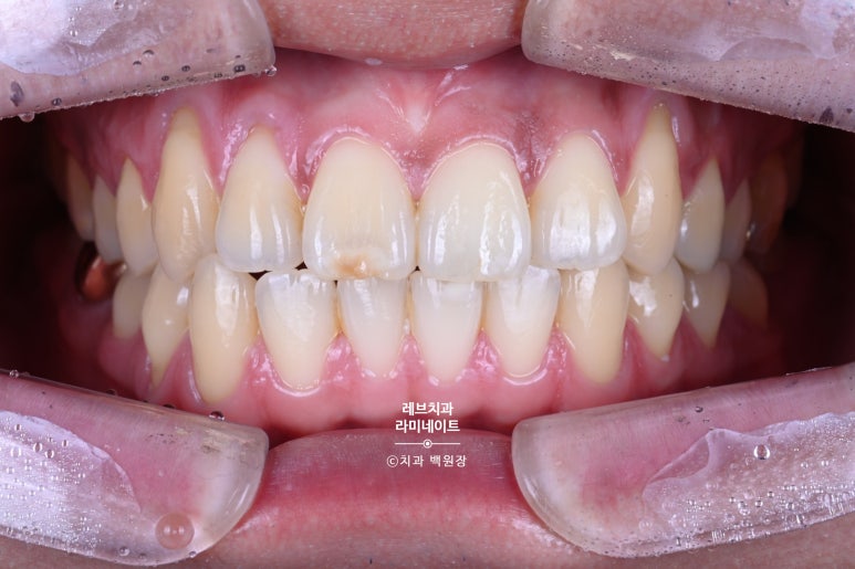 레브네이트 마스터 ; 예비신랑 앞니 무삭제라미네이트. 신사역 치과. 치료후기/비용/가격. 관련 이미지 4
