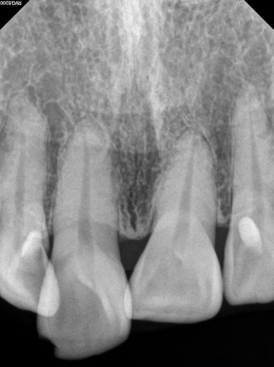 삐뚤어진 앞니를 8개월만에 가지런하게 만드는 50대 성인부분교정. 신사역 교정치과. 치료과정/기간/비용. 관련 이미지 8