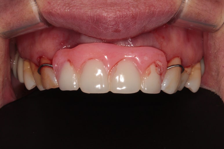 앞니가 풍치로 흔들거려요. 심한 치주염인데 임플란트 가능할까요? 치료과정/치료기간/비용/성공후기. 신금호역 치과 추천. 관련 이미지 8