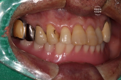 아래 어금니 임플란트 6개면 틀니를 안써도 됩니다.  치주염 전문 착한치과. 치료기간/임시치아과정/후기/비용. 관련 이미지 3