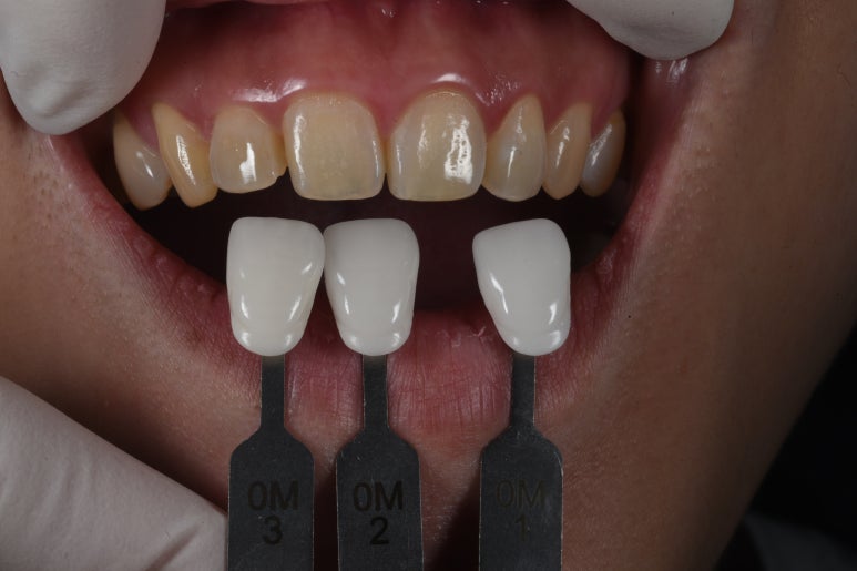 신사역 라미네이트. 결혼식 전 앞니 고민, 얇은 세라믹 레브네이트로 해결! 관련 이미지 12