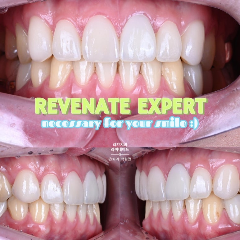 레브네이트 엑스퍼트 ; 유튜버가 선택한 앞니 라미네이트. 앞니 레진 벌어짐을 자연스러우면서 화사하게 바꿔봅시다. 신사역 치과. 치료후기/비용/가격. 관련 이미지 19