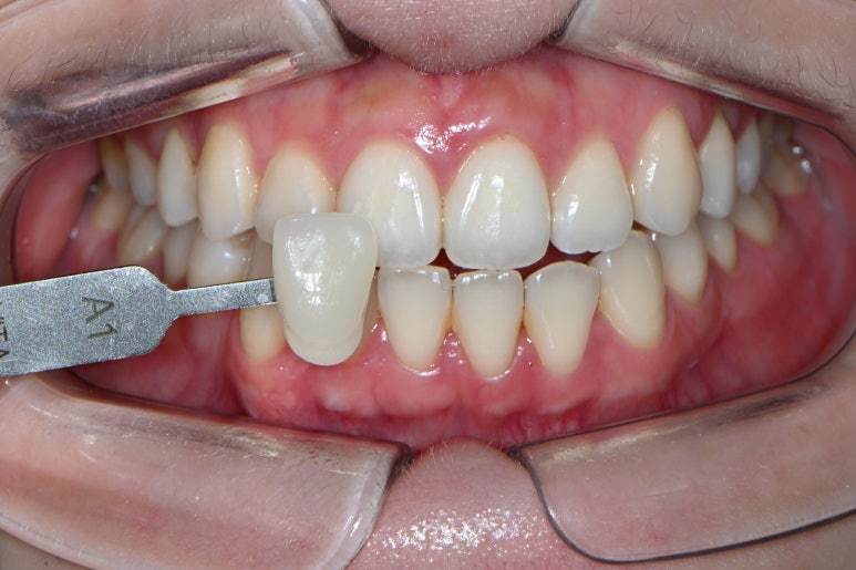 옆면 어금니 충치 하루만에 가능한 논현동 치과. 치아미백 가격 후기. 관련 이미지 4