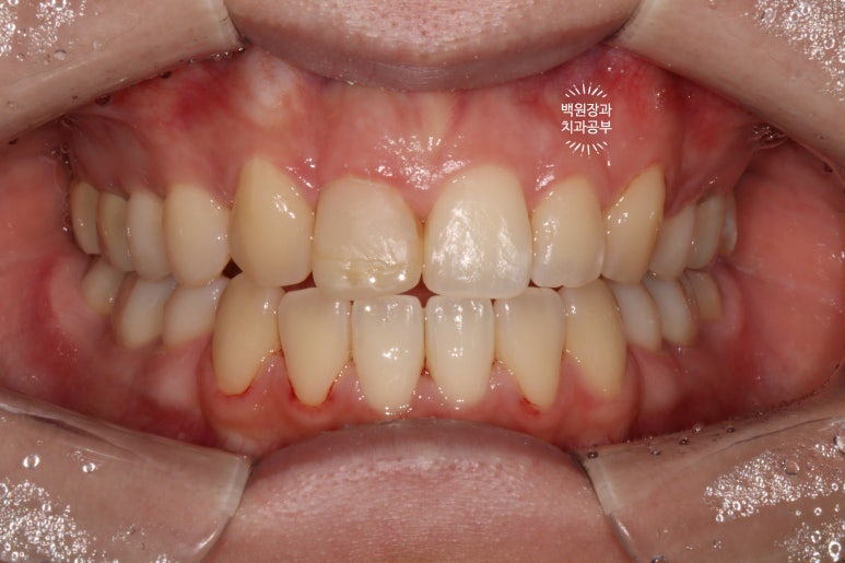 잇몸 성형과 치아미백 그리고 지르코니아 20대 앞니 크라운 치료. 치료과정/기간/비용. 관련 이미지 7
