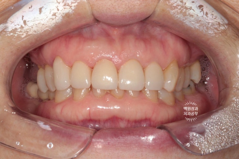 삐뚤빼뚤 앞니 세로 금  - 신경치료 없이 지르코니아 크라운으로. 상악동뼈이식술 임플란트. 관련 이미지 9