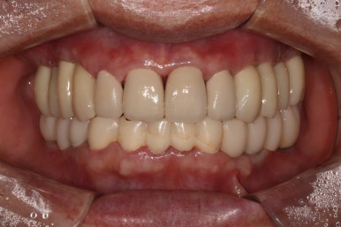 어금니 여러개가 없어요. 전체 임플란트와 앞니 크라운을 통한 완벽한 재건!! 치료과정/치료기간/비용/후기. 관련 이미지 24