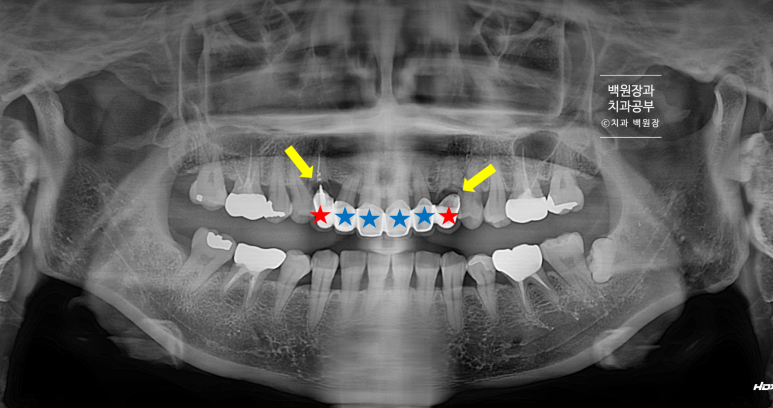 크라운 앞니 충치로 냄새가 나요 - 최소한의 임플란트와 씌우는 치료. 치료과정/기간/비용. 관련 이미지 4