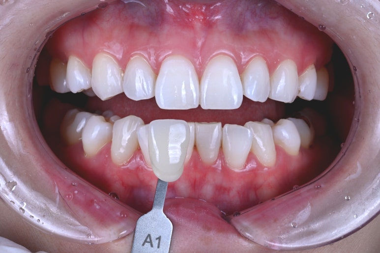 강남 치아미백 성지 레브치과. 가격/비용/부작용/전후사진. 관련 이미지 16