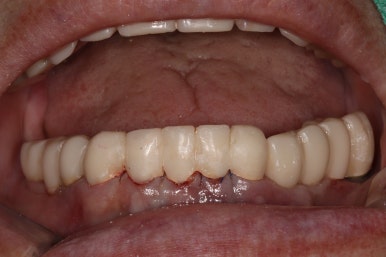 어금니 여러개가 없어요. 전체 임플란트와 앞니 크라운을 통한 완벽한 재건!! 치료과정/치료기간/비용/후기. 관련 이미지 19