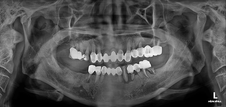 잇몸 염증 고름이 심했던 부위 - 만성치주염 진단하고 임플란트로 깔끔하게 치료! 신사역 치과 관련 이미지 3