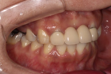 전세계 1위 스트라우만 임플란트를 사용한 어금니 기능회복과 앞니 지르코니아 크라운 증례. 관련 이미지 3