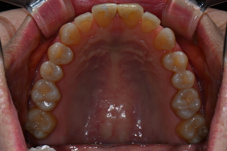 레브네이트 엑스퍼트 - 앞니 무삭제 라미네이트. 40대 벌어진 앞니에 변색된 레진은 이제 그만! 압구정 치과 추천 전후/비용. 관련 이미지 6