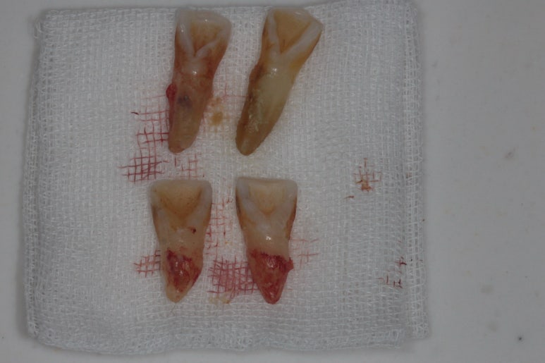 앞니가 풍치로 흔들거려요. 심한 치주염인데 임플란트 가능할까요? 치료과정/치료기간/비용/성공후기. 신금호역 치과 추천. 관련 이미지 9
