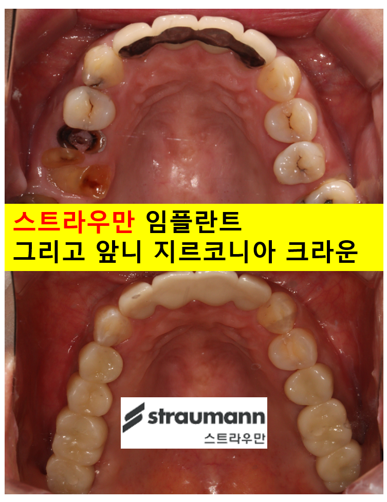 전세계 1위 스트라우만 임플란트를 사용한 어금니 기능회복과 앞니 지르코니아 크라운 증례. 관련 이미지 1
