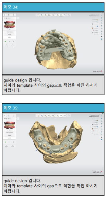 아래 어금니 임플란트 6개면 틀니를 안써도 됩니다.  치주염 전문 착한치과. 치료기간/임시치아과정/후기/비용. 관련 이미지 11