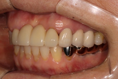 60대 임플란트 주변에서 고름이 나와요. 실패한 임플란트 제거 후 재수술. 덴티움 뼈이식재를 사용한 치조골 이식술. 관련 이미지 12