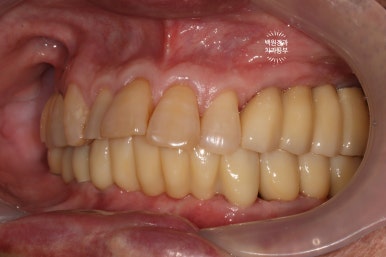 아래 어금니 임플란트 6개면 틀니를 안써도 됩니다.  치주염 전문 착한치과. 치료기간/임시치아과정/후기/비용. 관련 이미지 26