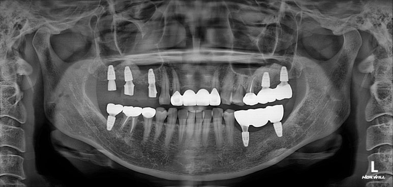 전세계 1위 스트라우만 임플란트를 사용한 어금니 기능회복과 앞니 지르코니아 크라운 증례. 관련 이미지 18