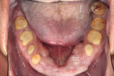 뿌리만 남은 앞니, 어금니가 없어 교합이 무너진 증례. 흡연자의 전체 오스템BA임플란트 재건증례. 치료과정/치료기간/비용/후기. 관련 이미지 15