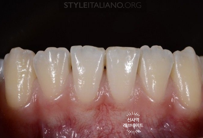 What About Laminates at Sinsa Station? Rev Dental Clinic’s Revnate. image 15