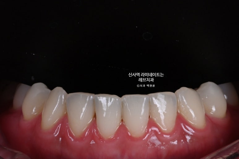 신사역 라미네이트, 잘하는 치과의 치료과정과 재료.설명.비용.후기. 관련 이미지 8