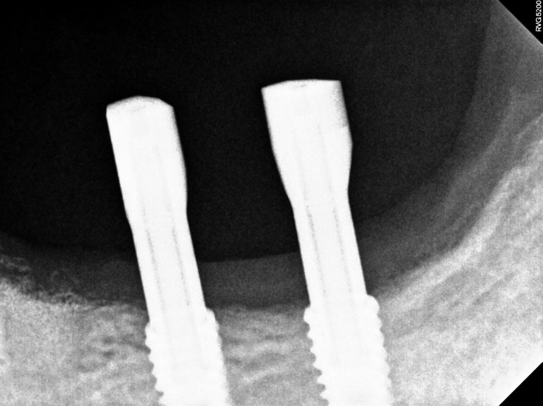 어금니 임플란트 주변 잇몸이식수술 - 저는 해야한다고 생각합니다. (feat. 대한치과의사협회 논문 + 치주과전문) 관련 이미지 23