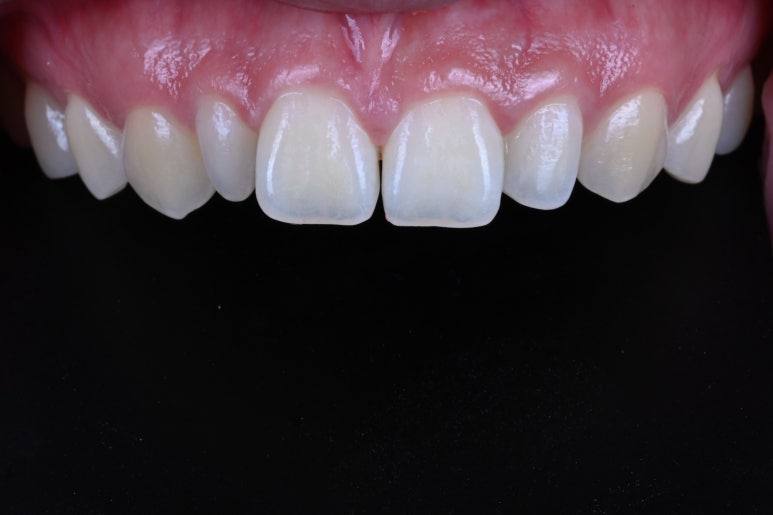 왜소치 라미네이트. 열심히 교정치료 받은 나를 위한 선물. 비용/과정/후기. 관련 이미지 6