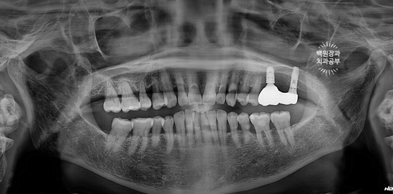 치아와 임플란트를 연결하면 치아가 망가집니다. 발치 동시 치조골 이식 후 임플란트. 치료과정/치료기간/비용/후기. 관련 이미지 15