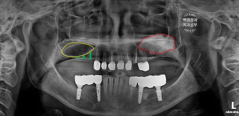 부분틀니 대신 어금니 임플란트를 만들어드립니다. 40대 어금니 상악동 뼈이식 임플란트. 치료기간/비용/과정. 관련 이미지 6