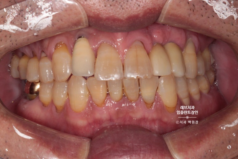 앞니 부러짐? 뽑고 바로 임플란트 + 뼈이식. 앞니 흔들림? 뽑고 1달 기다리고 임플란트 + 뼈이식. 신사역 치과 후기/비용/과정. 관련 이미지 18